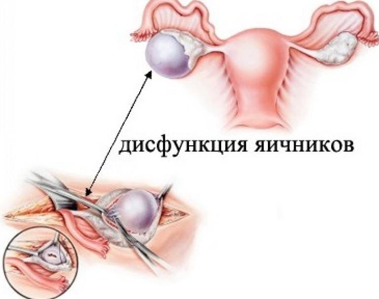 Дисфункция яичников - одна из причин болей в сосках
